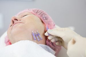Woman Doing Thread Lifting Treatment